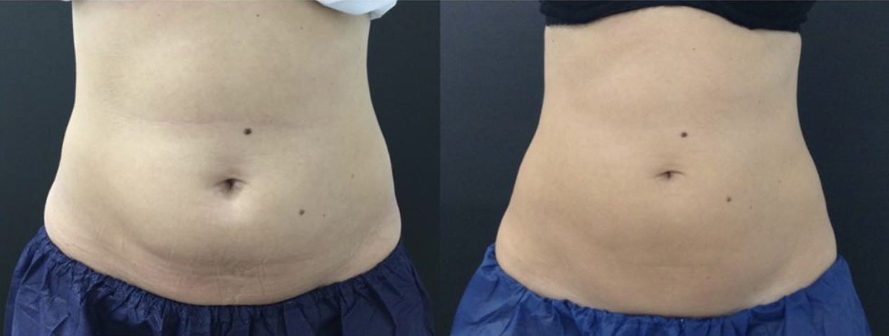 Cryolipolysis Before & After