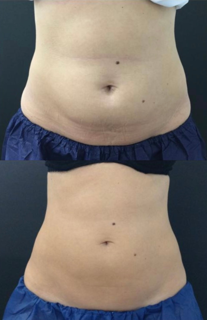 Cryolipolysis Before & After