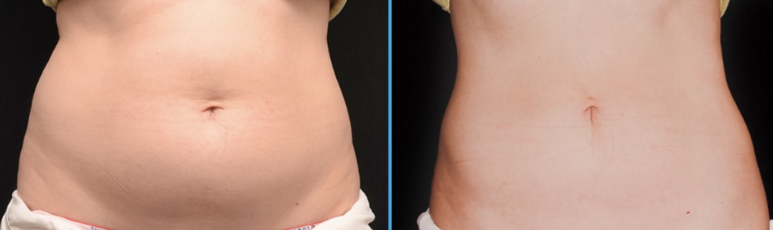 Cryolipolysis Before & After