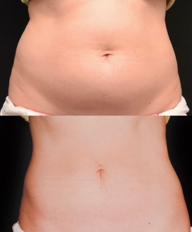 Cryolipolysis Before & After