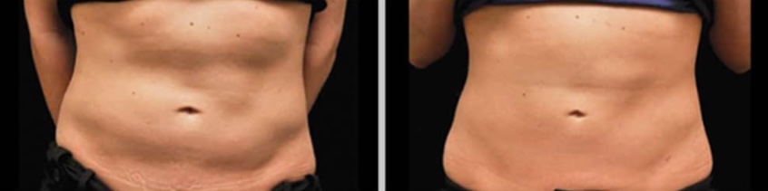 Cryolipolysis Before & After