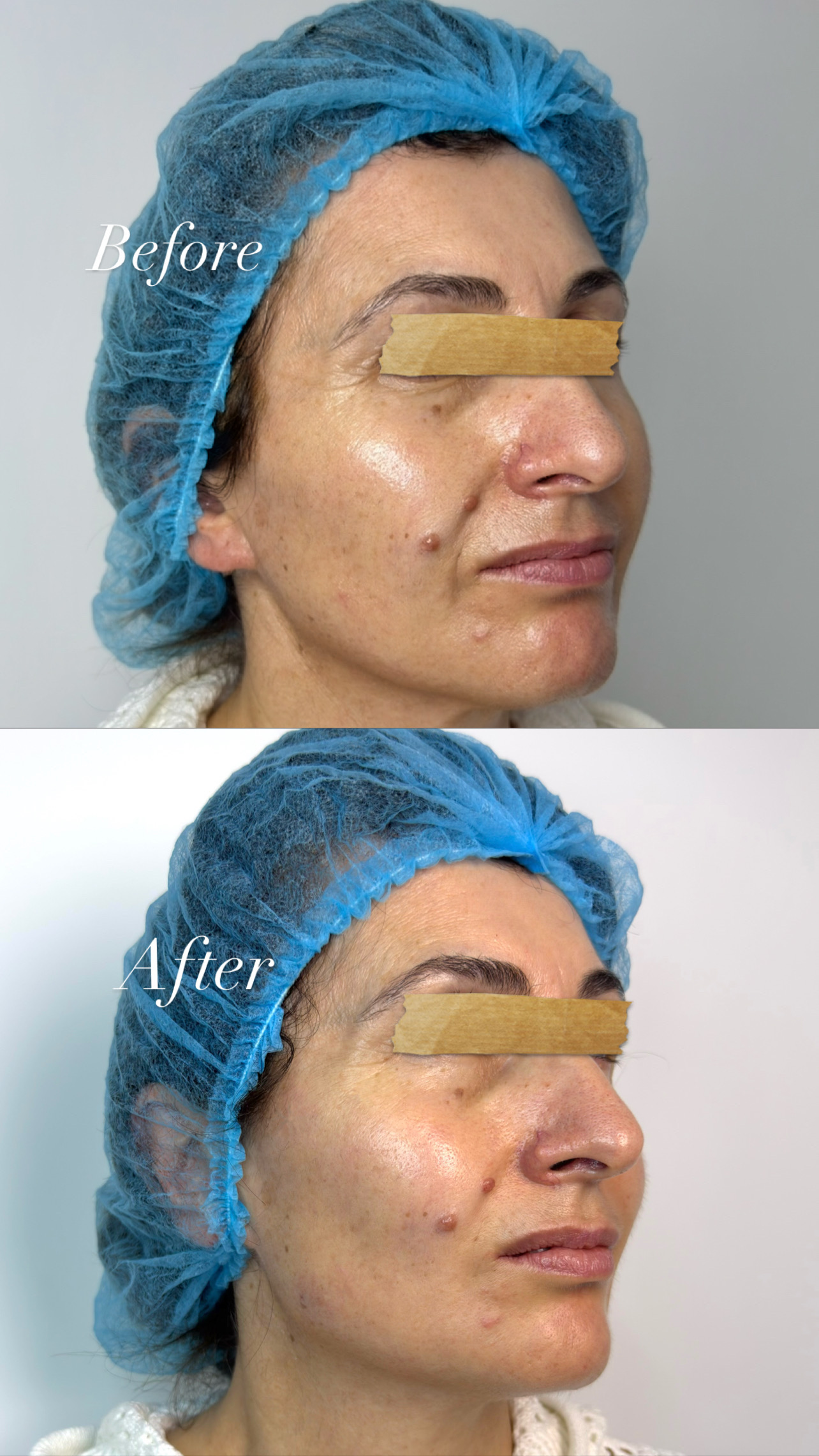 Ellure Before & After