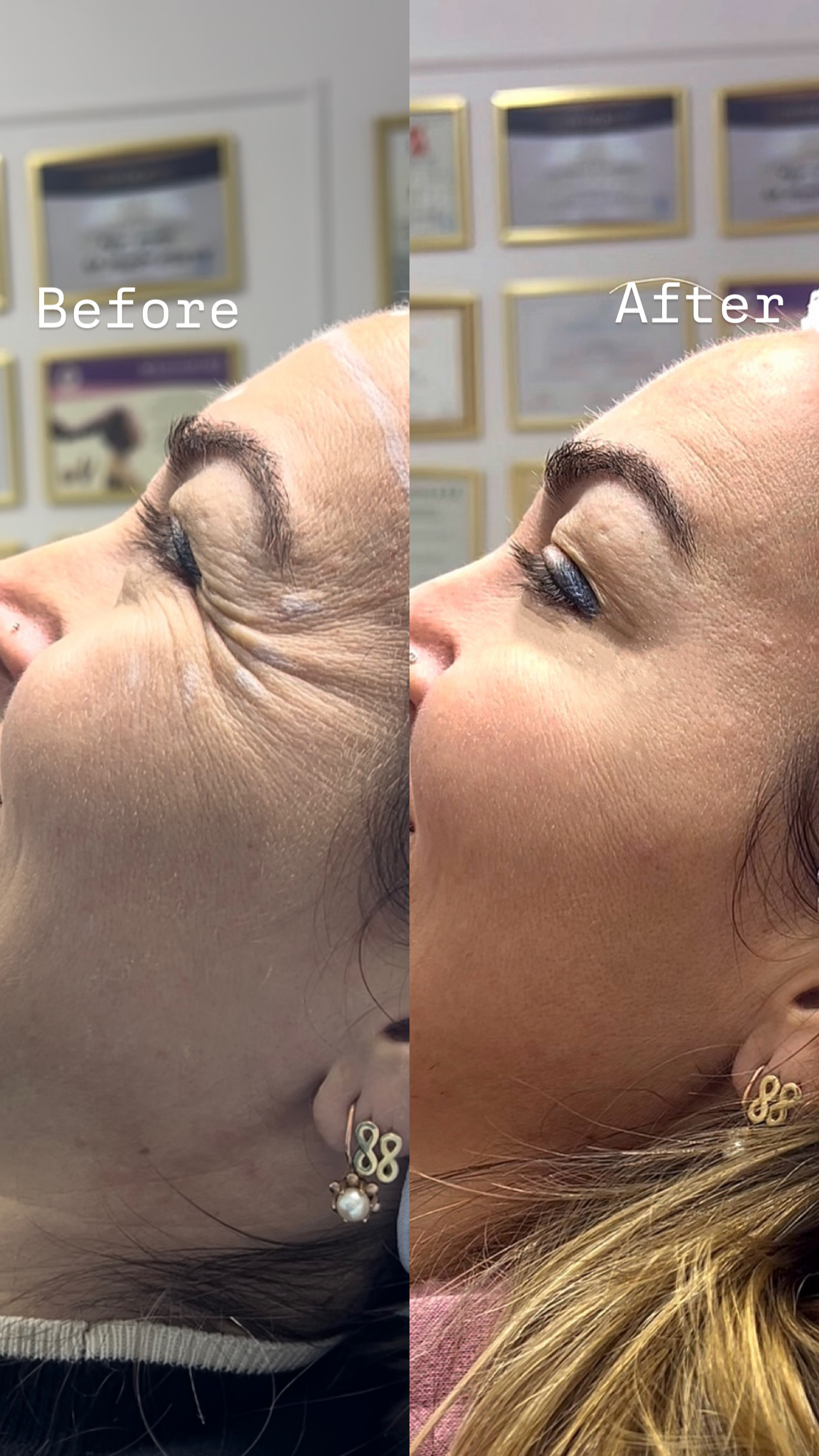 Botox Eye Area Before & After