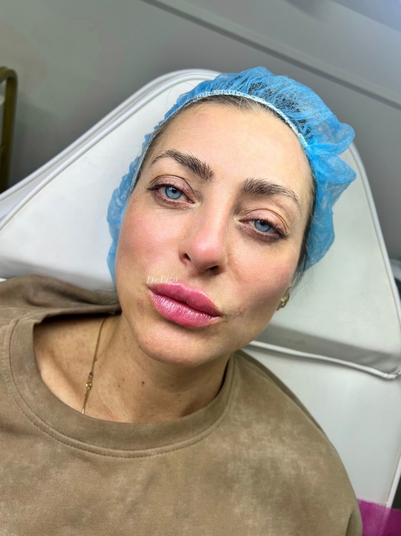 Lip Filler Before & After